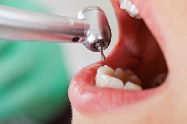 Best Knocked-Out Tooth (Avulsed Tooth) Treatment in Tomah, WI